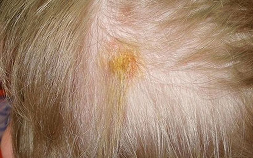 trattamento e sintomi dei funghi del cuoio capelluto