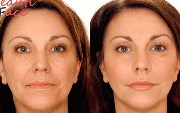 L'effetto della mesoterapia facciale