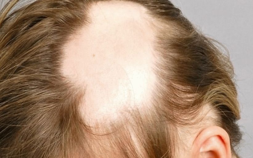 minoxidil per recensioni di capelli