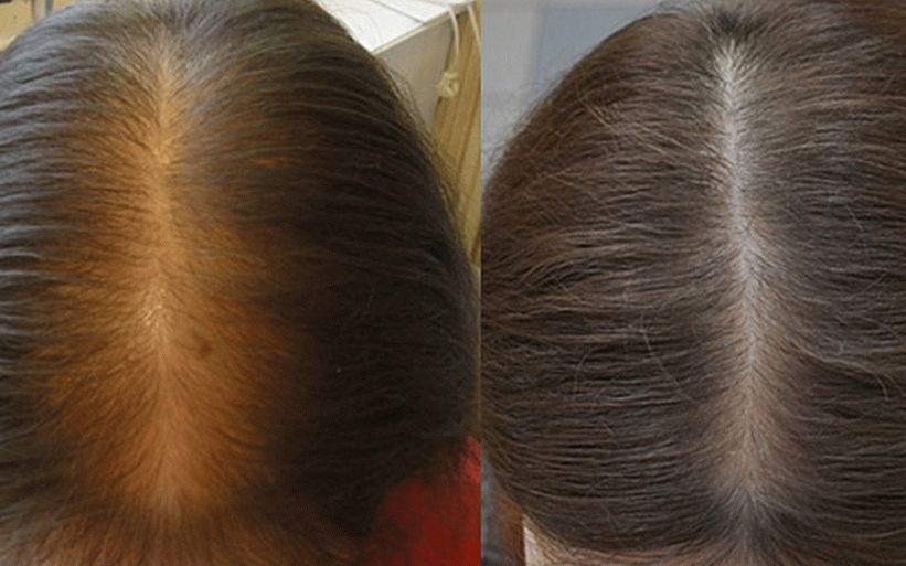 minoxidil per recensioni di capelli