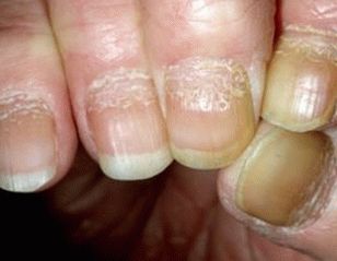 psoriasi delle unghie