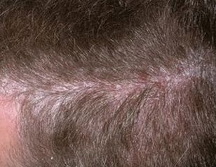 malattia della psoriasi del cuoio capelluto e del cuoio capelluto, foto della fase iniziale