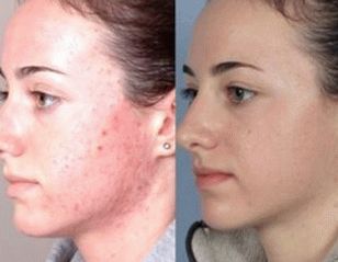 foto della pelle del viso dopo il trattamento della psoriasi