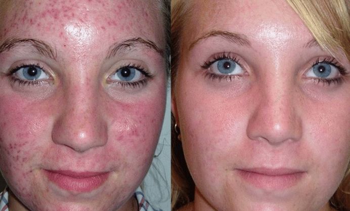 foto della pelle del viso dopo il trattamento della psoriasi