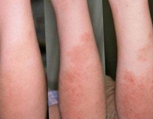 Come è la fase iniziale della psoriasi nella foto dei bambini?