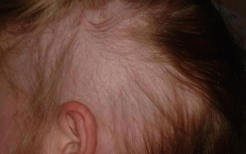 Cause e trattamento della perdita di capelli nei bambini