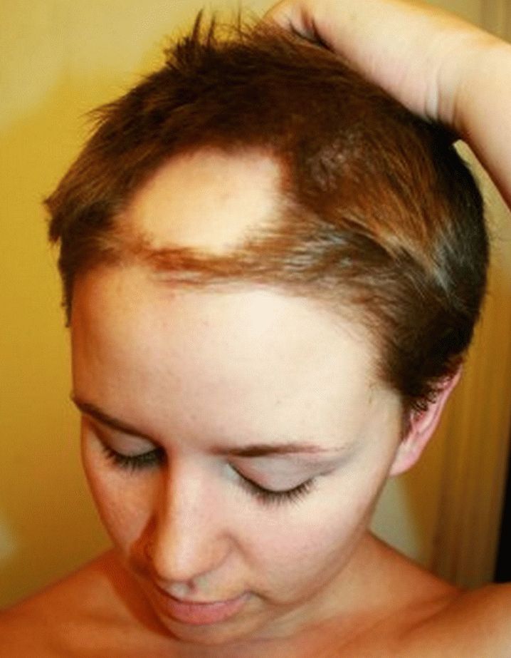 Cause e trattamento della perdita di capelli nei bambini